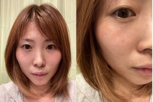 画像あり】韓国で話題のDPCスキンアイロンが凄い！口コミや効果は 